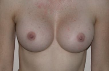 After Image: Breast Augmentation - front