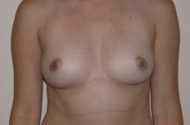 Before Image: Breast Augmentation - front