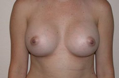 After Image: Breast Augmentation - front