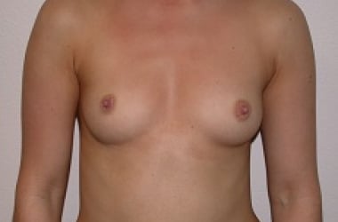 Before Image: Breast Augmentation - front