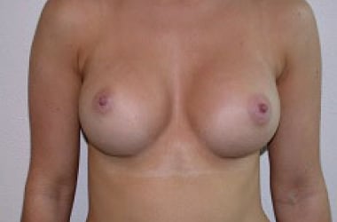 After Image: Breast Augmentation - front
