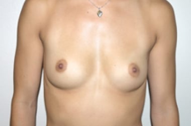 Before Image: Breast Augmentation - front