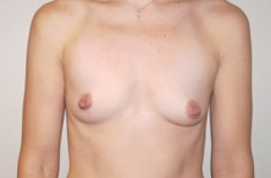 Before Image: Breast Augmentation - front