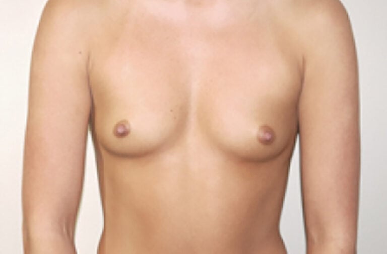 Before Image: Breast Augmentation - front