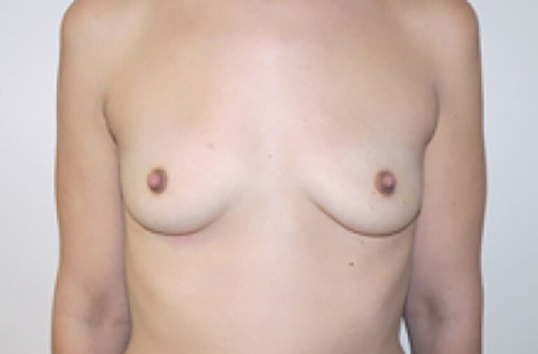 Before Image: Breast Augmentation - front