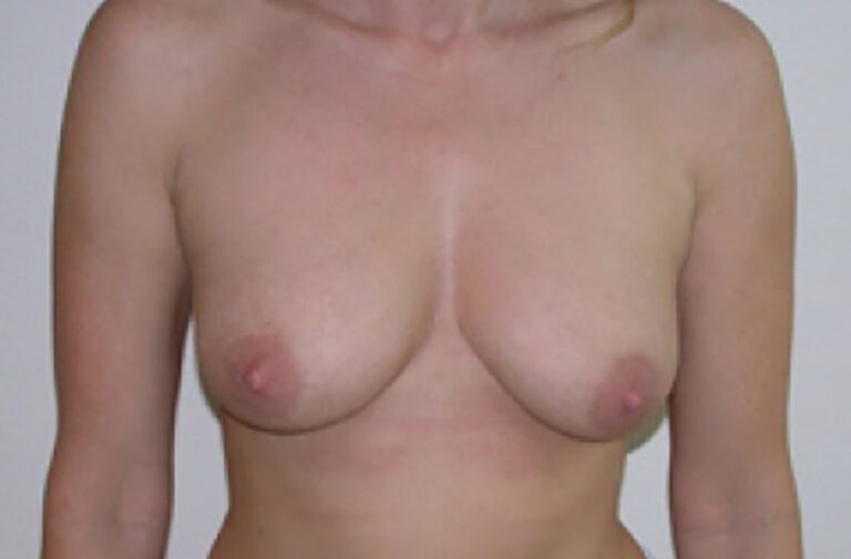 Before Image: Breast Augmentation - front