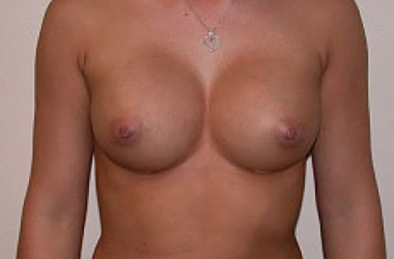 After Image: Breast Augmentation - front