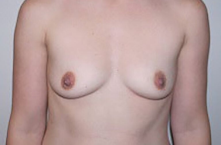 Before Image: Breast Augmentation - front