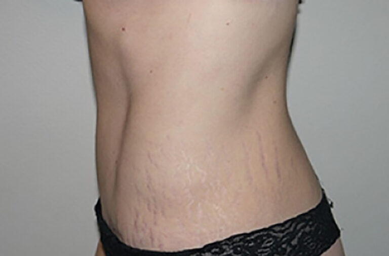 After Image: Abdominoplasty - left-side