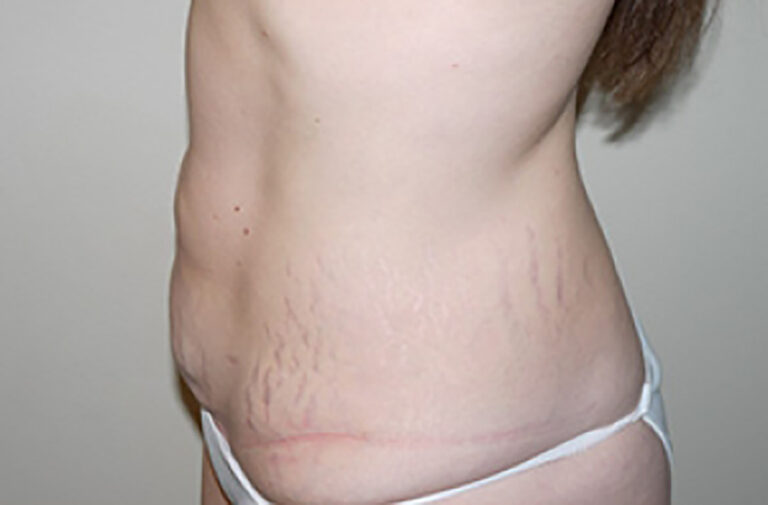 Before Image: Abdominoplasty - left-side