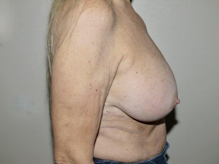 Before Image: Breast Implant Removal with Lift - right-side