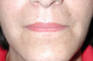 Lip Augmentation