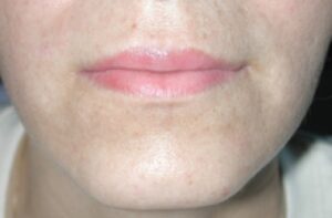 Lip Augmentation