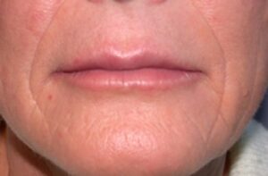 Lip Augmentation