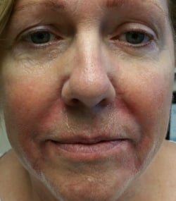 Juvederm