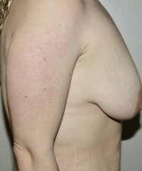 Before Image: Mastopexy - right-side