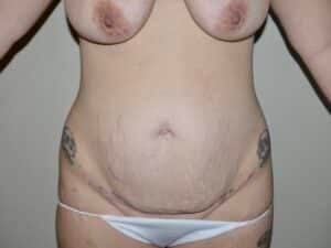 Abdominoplasty