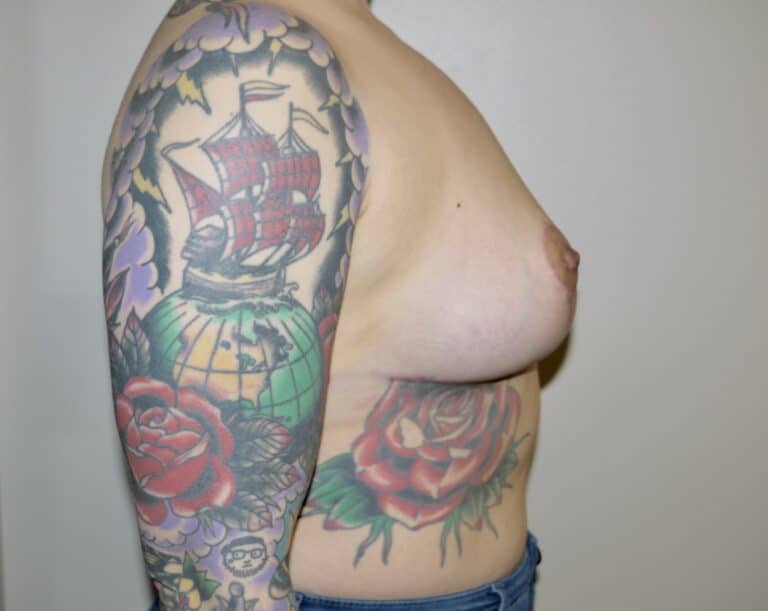 After Image: Breast Implant Removal with Lift - right-side