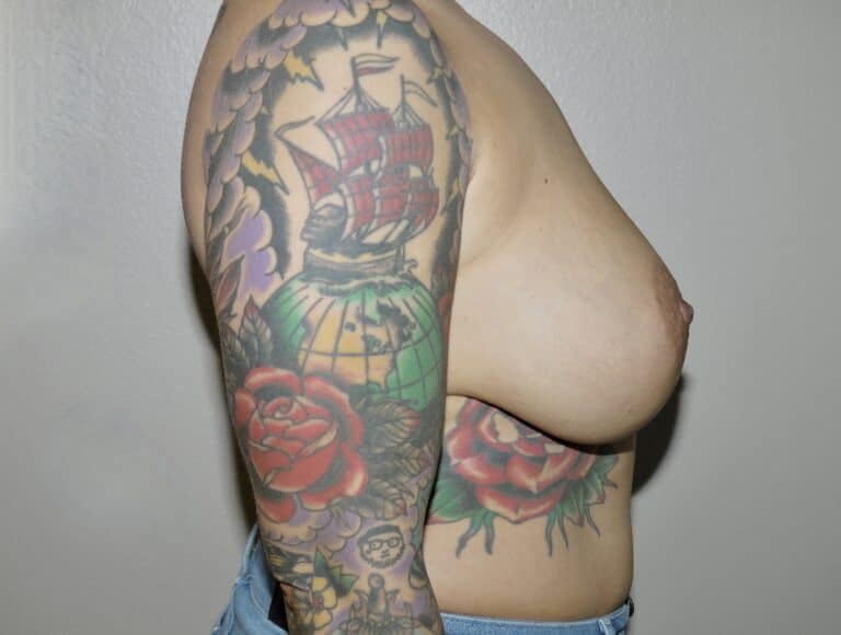 Before Image: Breast Implant Removal with Lift - right-side