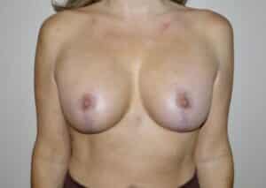 Breast Implant Revision