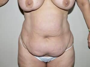 Abdominoplasty