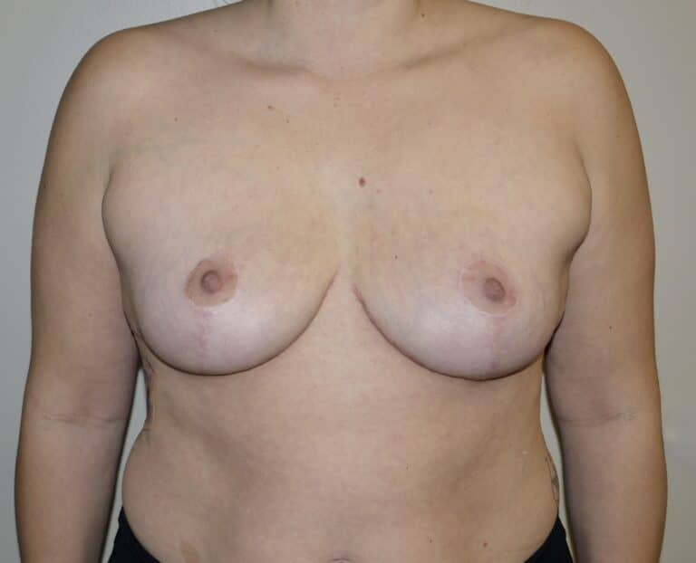 After Image: Breast Implant Removal with Lift - front