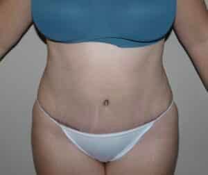 Abdominoplasty