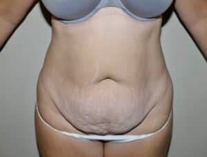 Abdominoplasty