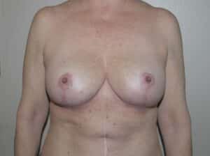 Breast Implant Removal with Lift