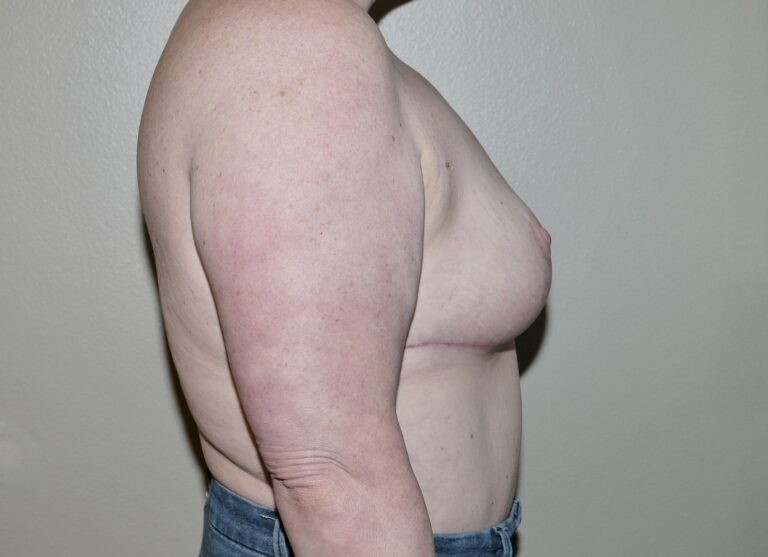 After Image: Breast Implant Removal with Lift - right-side