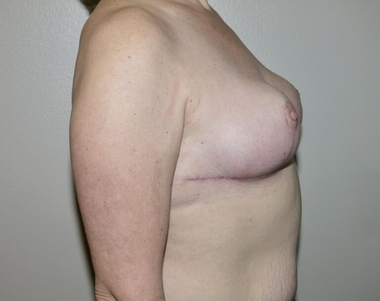 After Image: Breast Implant Removal with Lift - right-side
