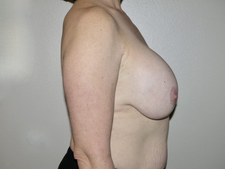 Before Image: Breast Implant Removal with Lift - right-side