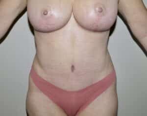 After Image: Abdominoplasty