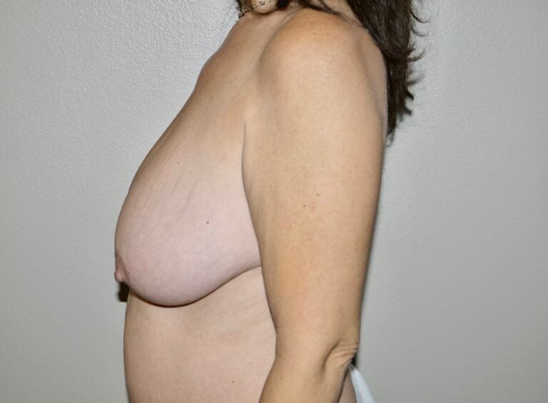 Before Image: Breast Lift - left-side