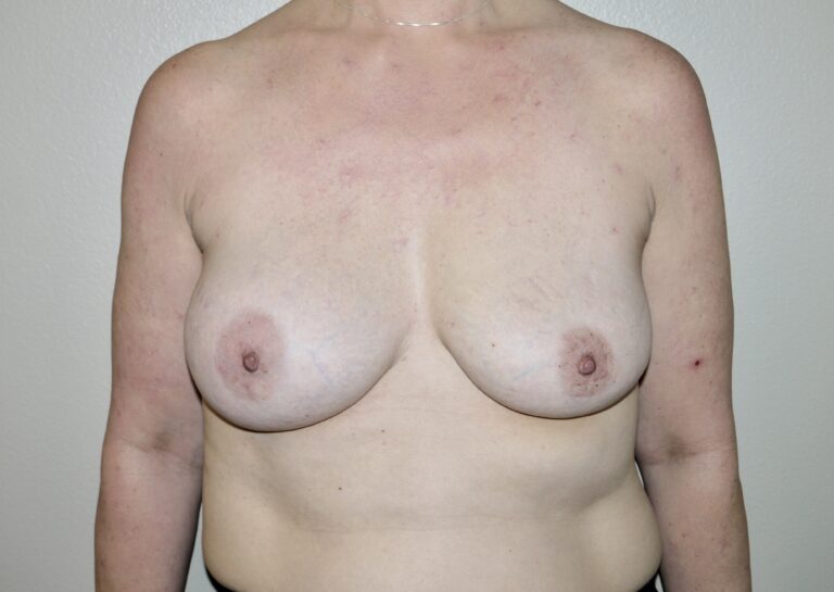 Before Image: Breast Implant Revisions - front