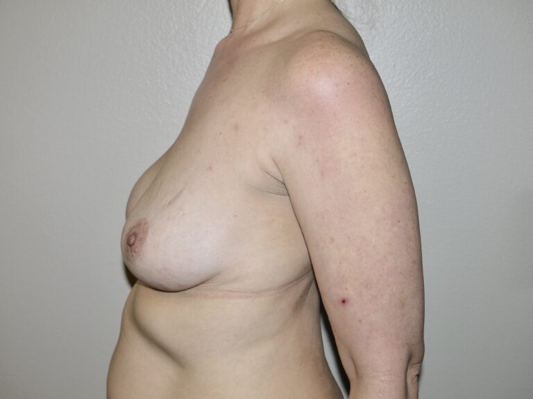 Before Image: Breast Implant Revisions - left-side
