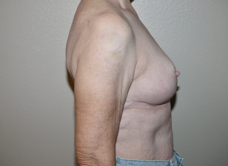 After Image: Breast Reduction - right-side
