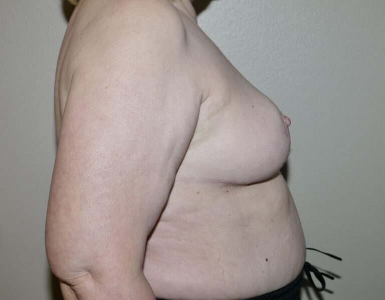 After Image: Breast Implant Removal with Lift - right-side