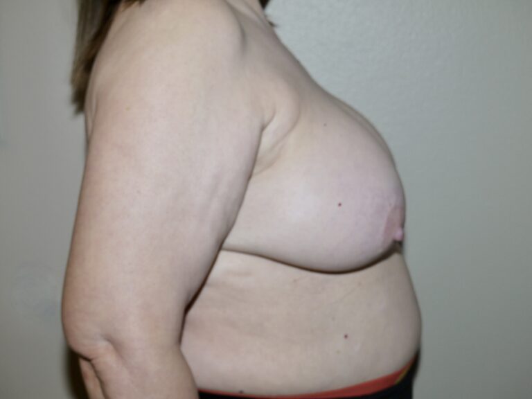 Before Image: Breast Implant Removal with Lift - right-side