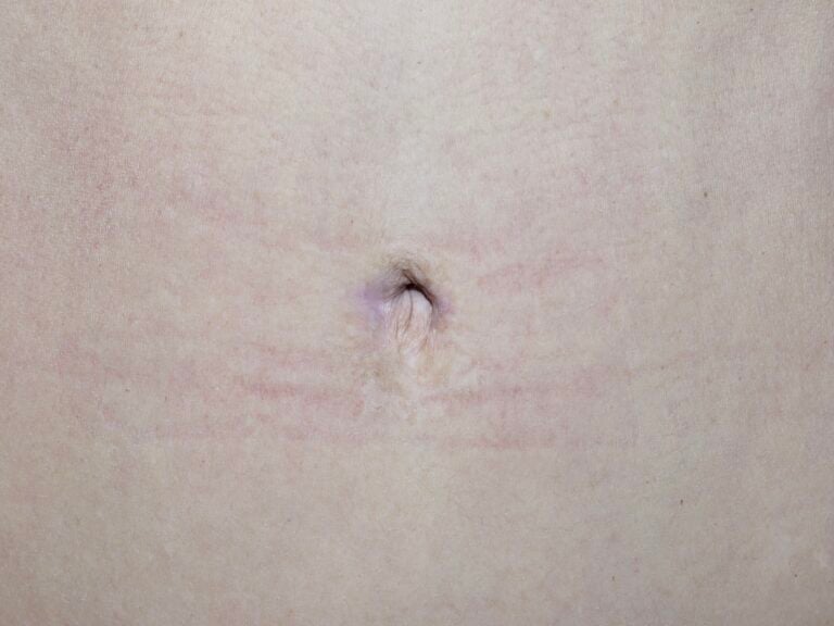 After Image: Abdominoplasty Revision -