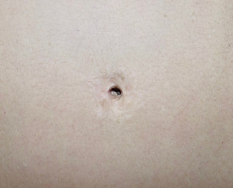 Before Image: Abdominoplasty Revision -
