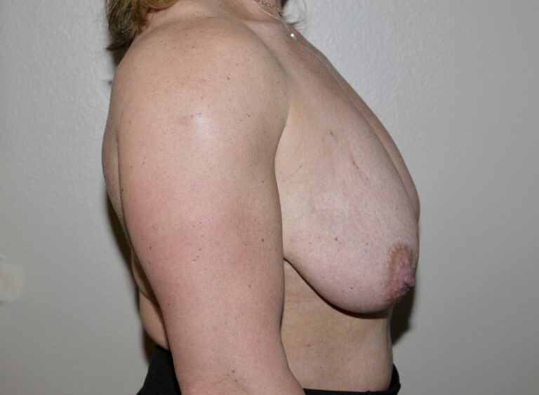 Before Image: Breast Lift - right-side