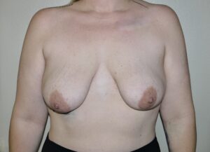Before Image: Breast Lift with Augmentation