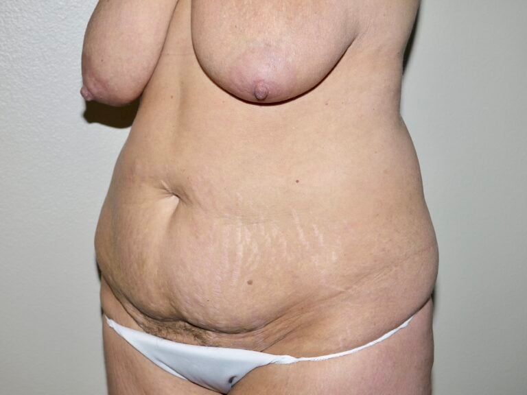 Before Image: Abdominoplasty - left-front-oblique