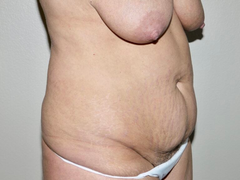 Before Image: Abdominoplasty - right-front-oblique