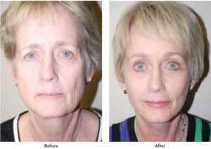 Before & after photo showing dramatic difference in woman's face after facelift performed by Dr. Hayley Brown.