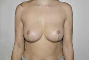 After Image: Breast Implant Removal with Lift