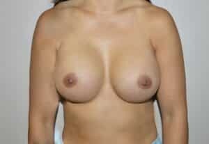 After Image: Breast Implant Revisions