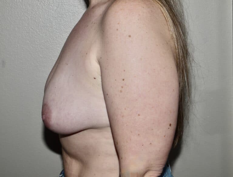 Before Image: Breast Lift with Augmentation - left-side