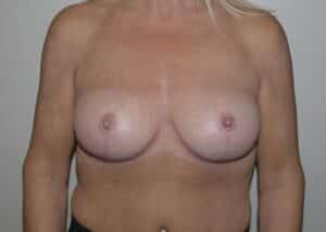 After Image: Breast Implant Removal with Lift